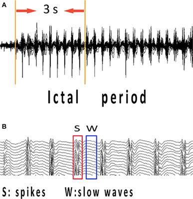 Changes of Ictal-Onset Epileptic Network Synchronicity in Childhood Absence Epilepsy: A Magnetoencephalography Study